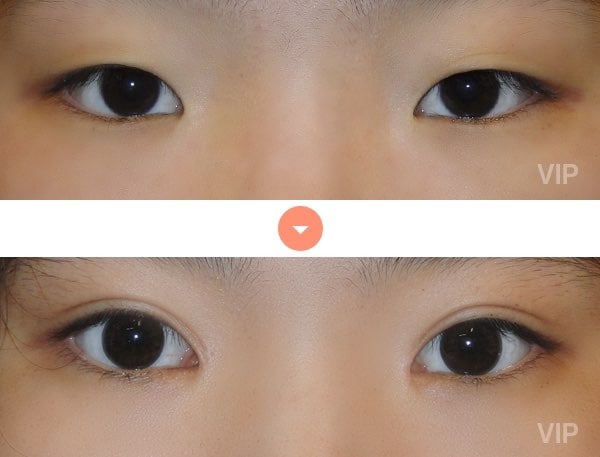 how much is eyelid surgery in korea