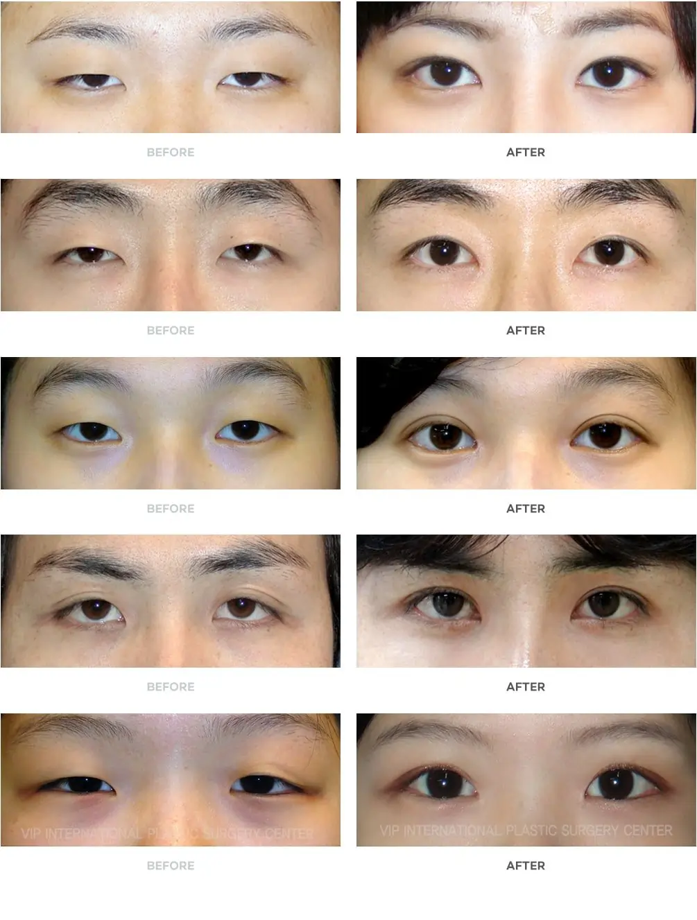 Non-Incision Double Eyelid Surgery Before and After Gallery