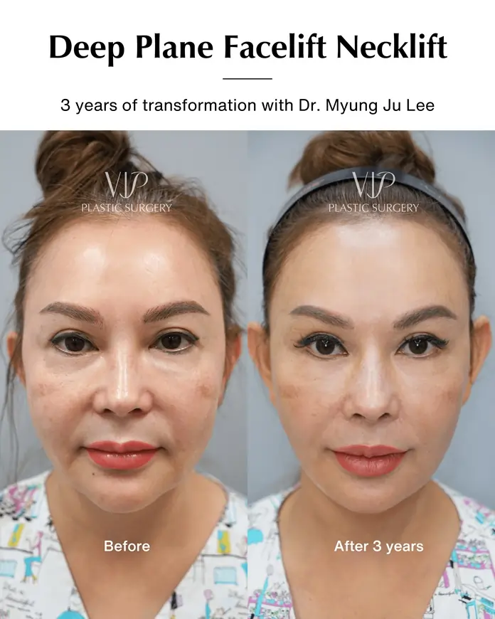 Deep plane facelift 3 years of transformation with Dr. Myung Ju Lee