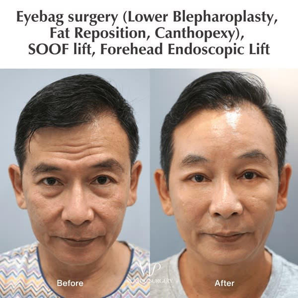 lower blepharoplasty before after photos