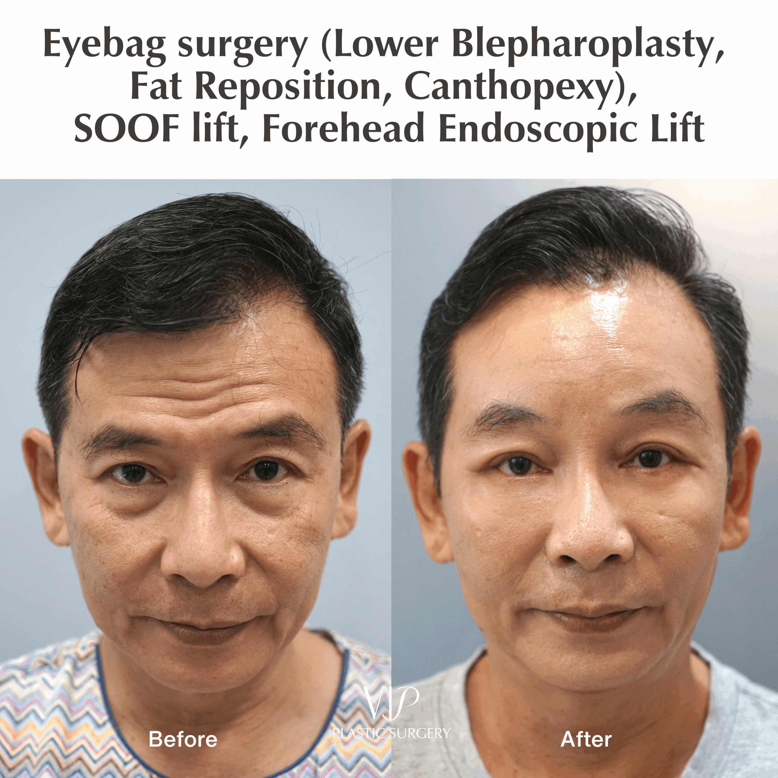How to Get Rid of Eye Bags: Effective Surgery Options & Results