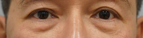 under-eye area
