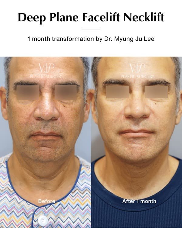 Deep plane facelift & Necklift by Dr. Myung Ju Lee.