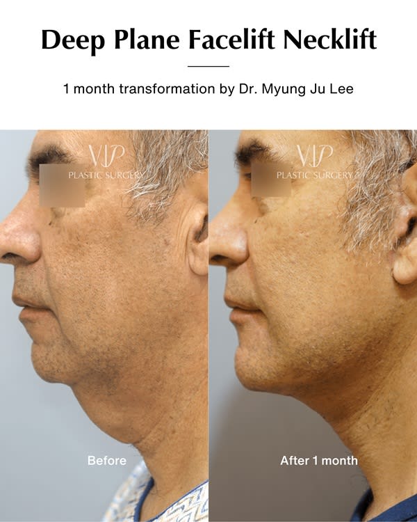 Deep Plane Facelift - one months transformation by Dr. Myung Ju Lee