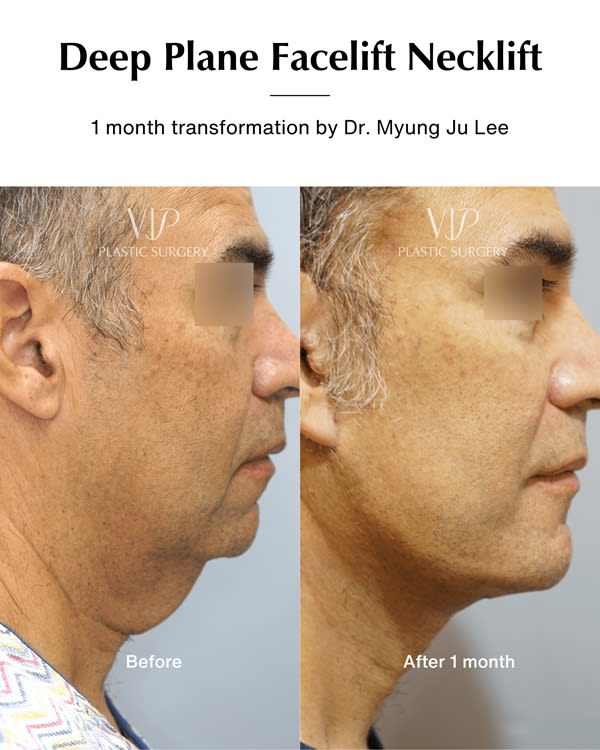 Facelift Photo on the right 1 month transformation