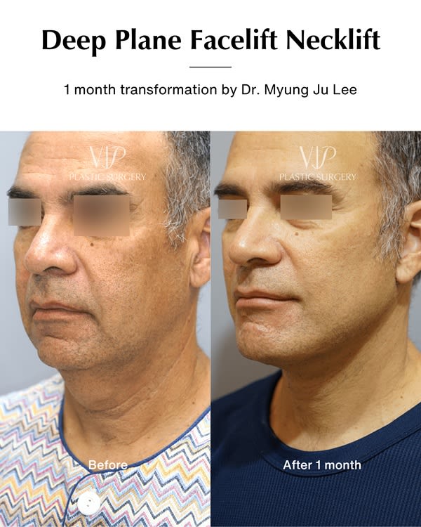 Facelift Photo on the left 1 month transformation