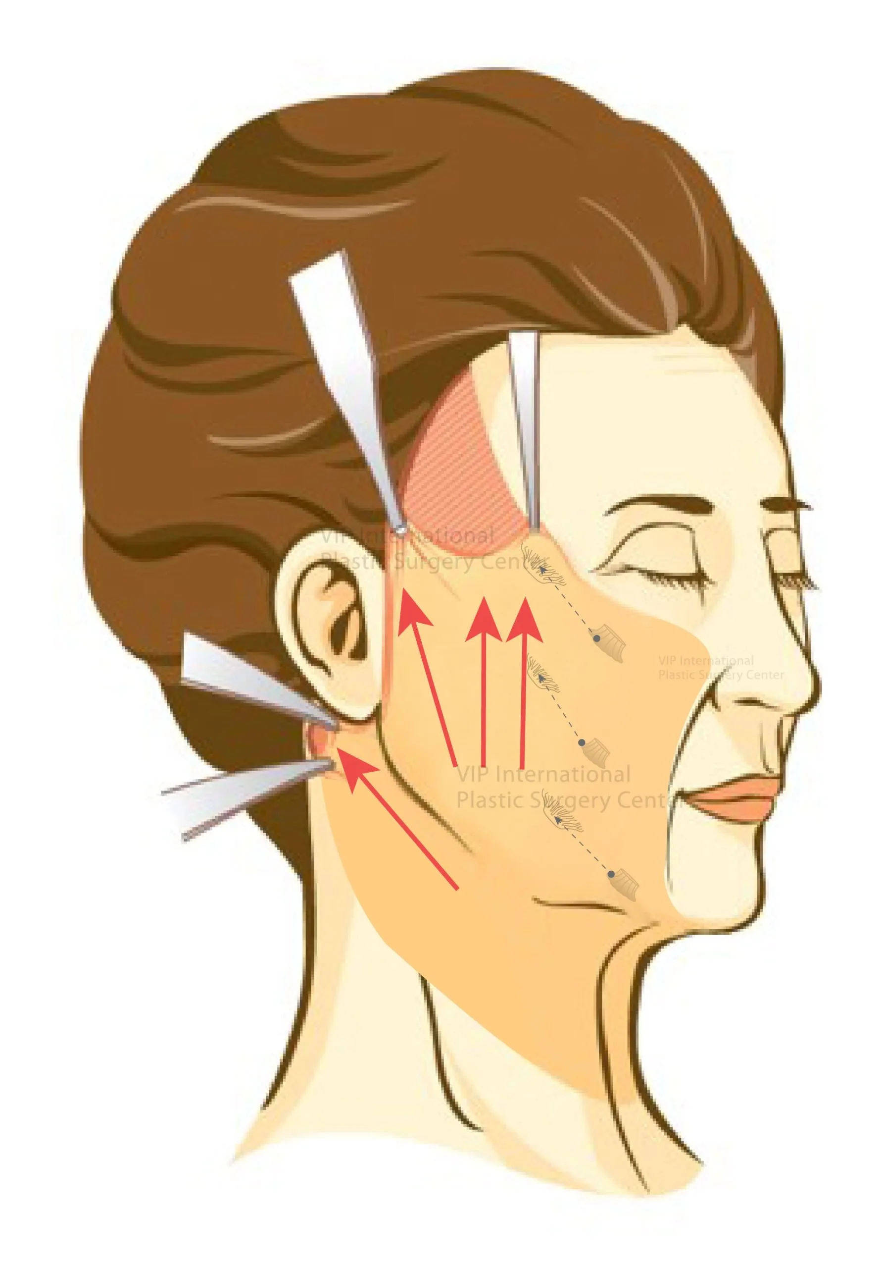 Facelift Surgery illustration