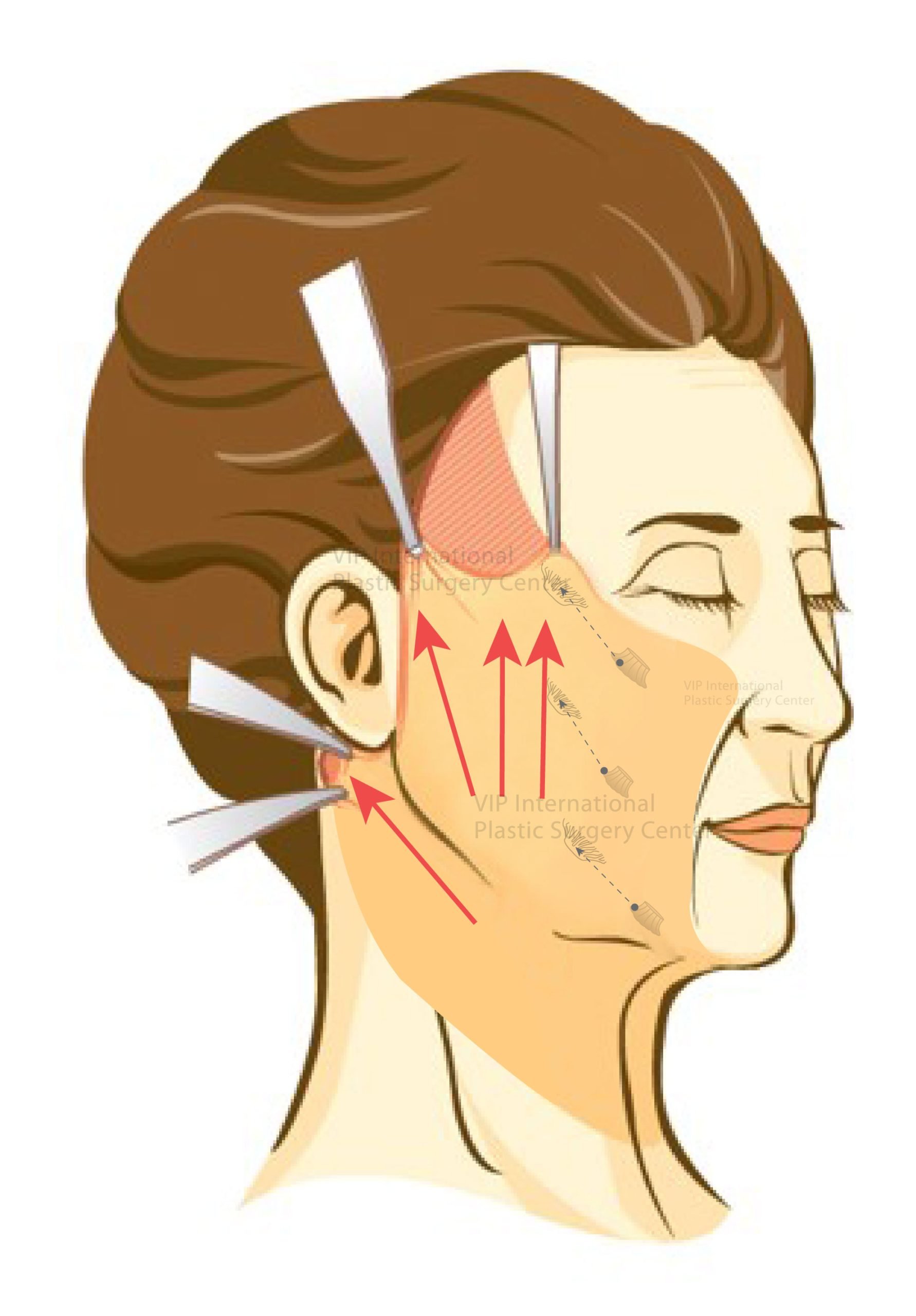 Average Facelift Cost in Korea 2025