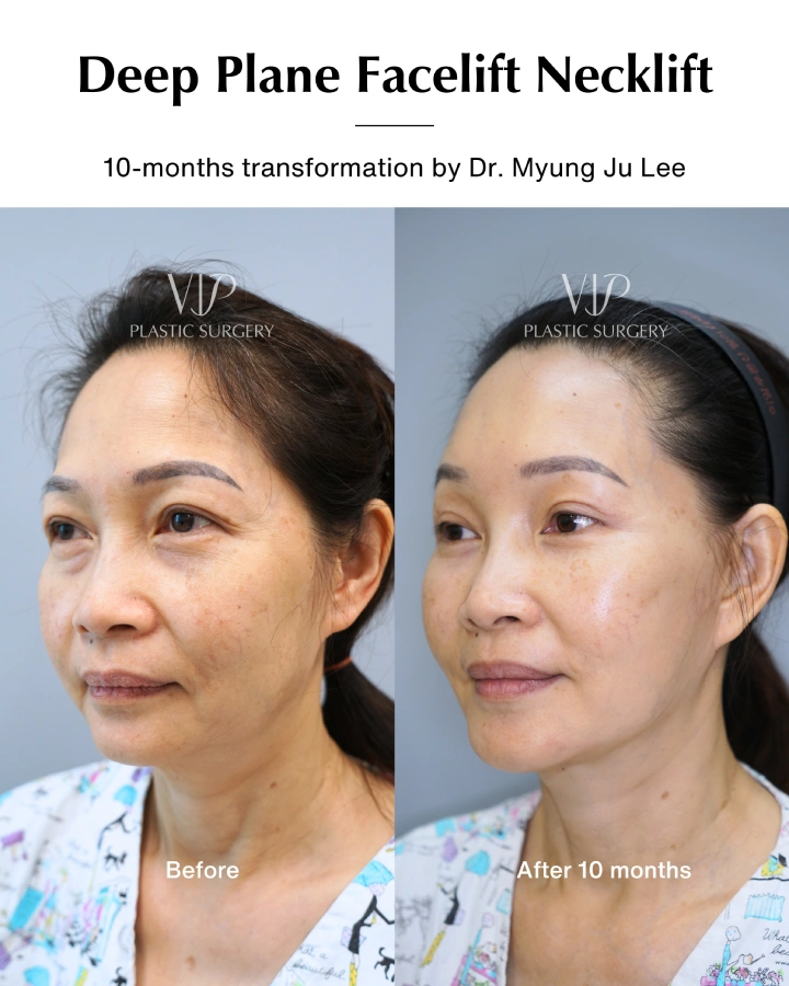 Deep Plane Facelift and Neck lift 10- months transformation 2