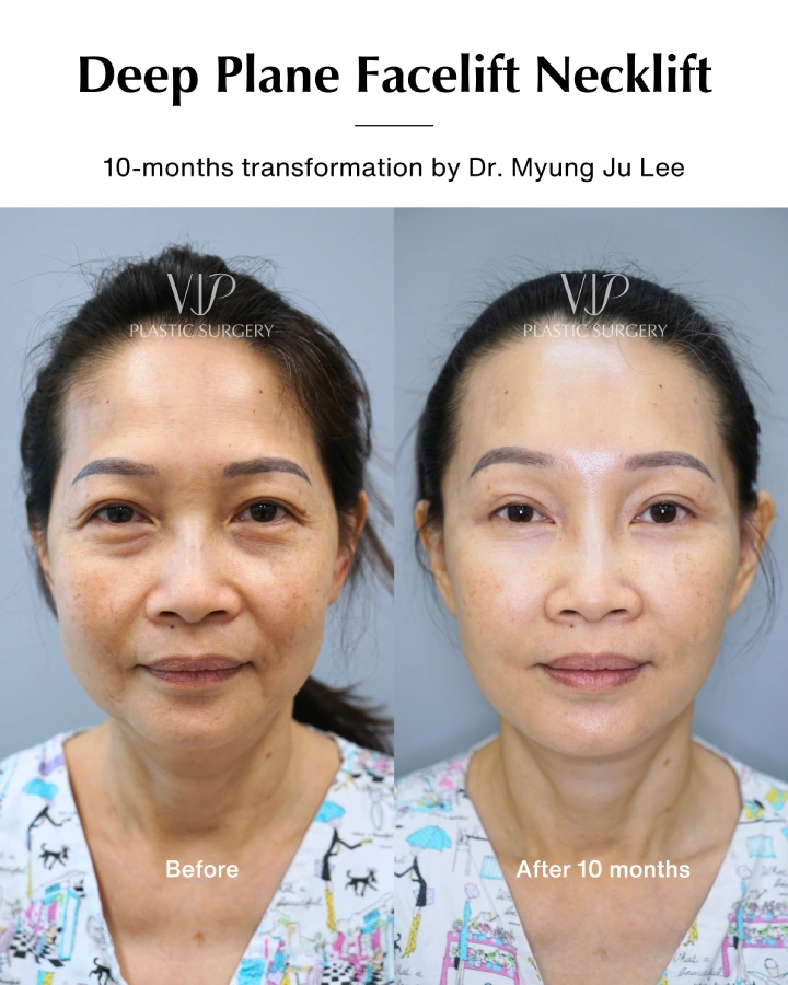 Deep Plane Facelift and Neck lift 10- months transformation