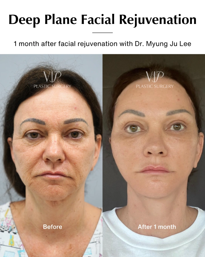 Deep Plane Facial Rejuvenation before and after gallery