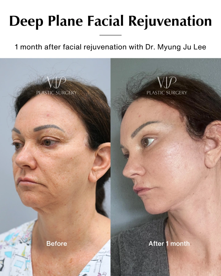 Deep Plane Facial Rejuvenation photos