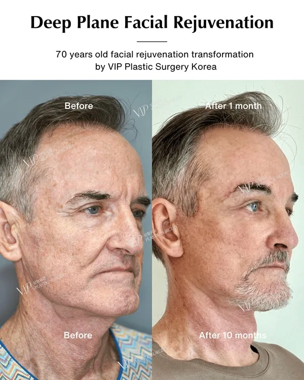 male deep plane facelift before after oblique