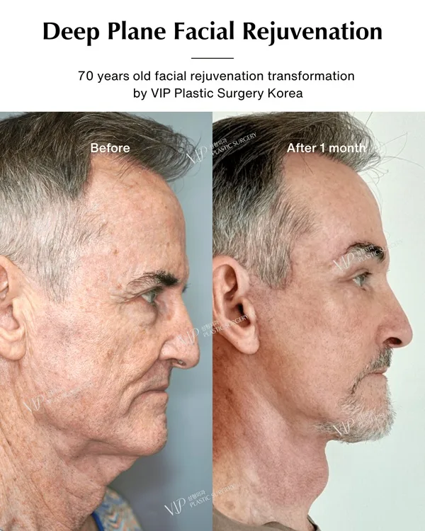 Deep Plane Facial Rejuvenation 3