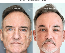 Male Full Facial Rejuvenation