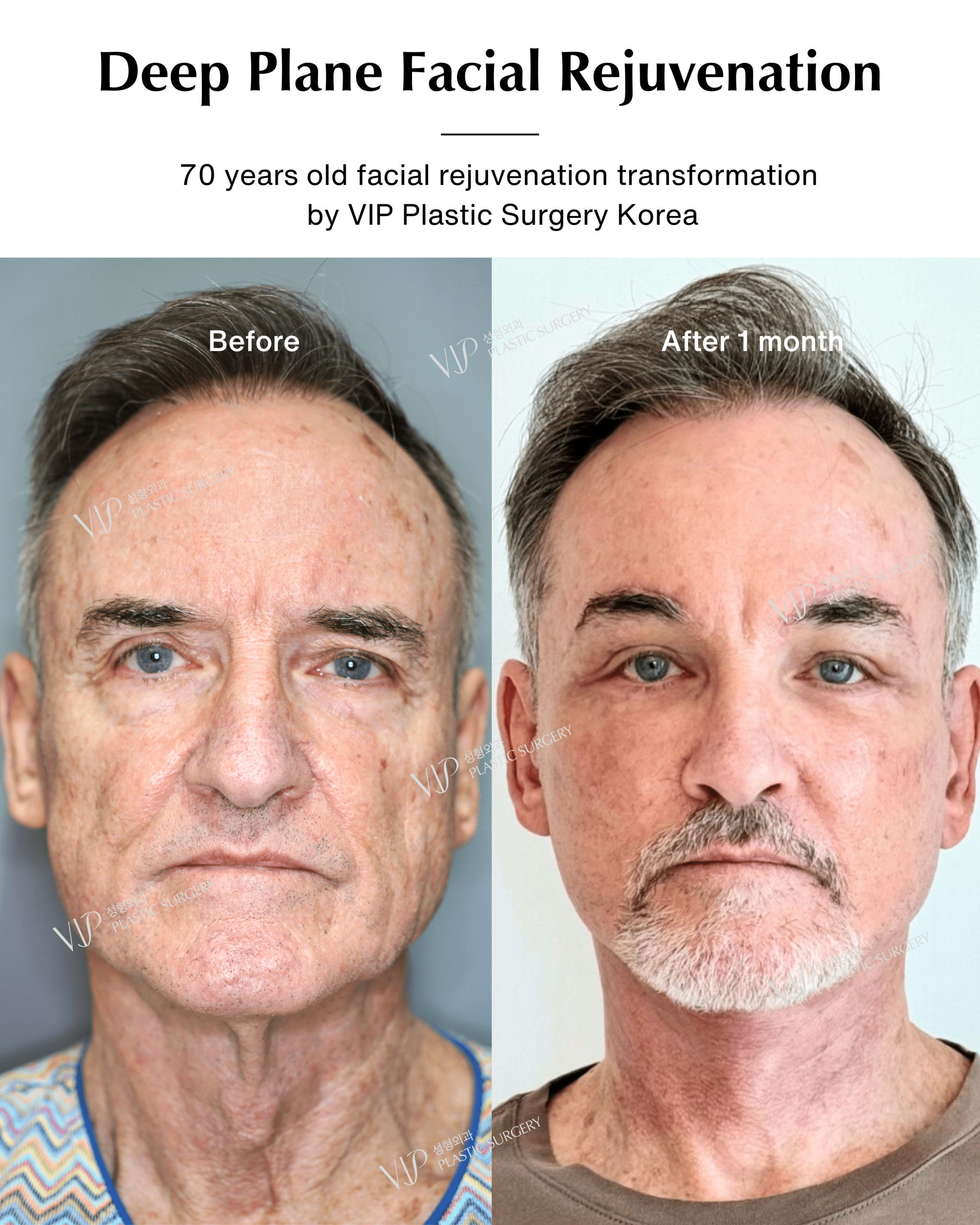 male deep plane facelift before after
