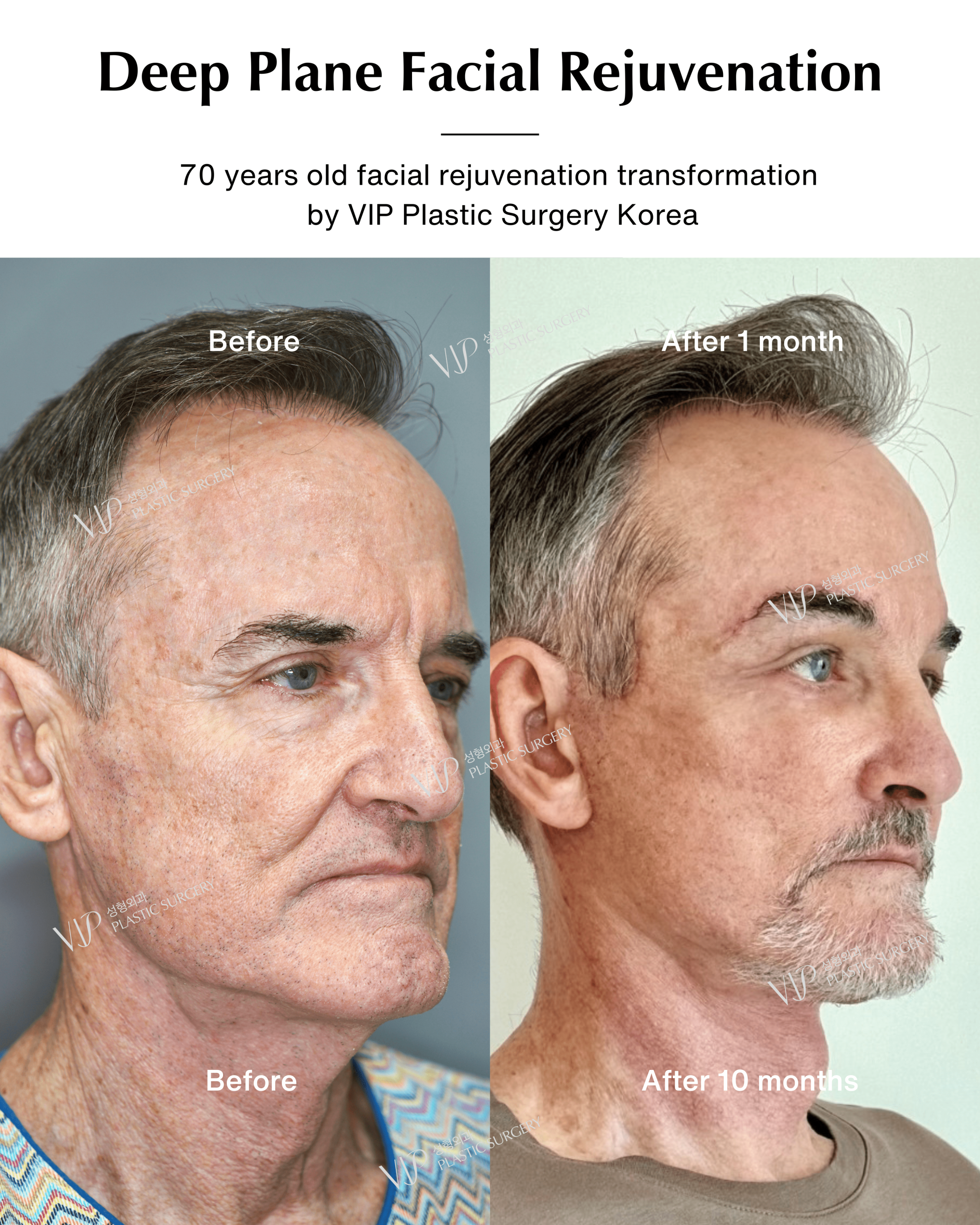 male deep plane facelift before after oblique