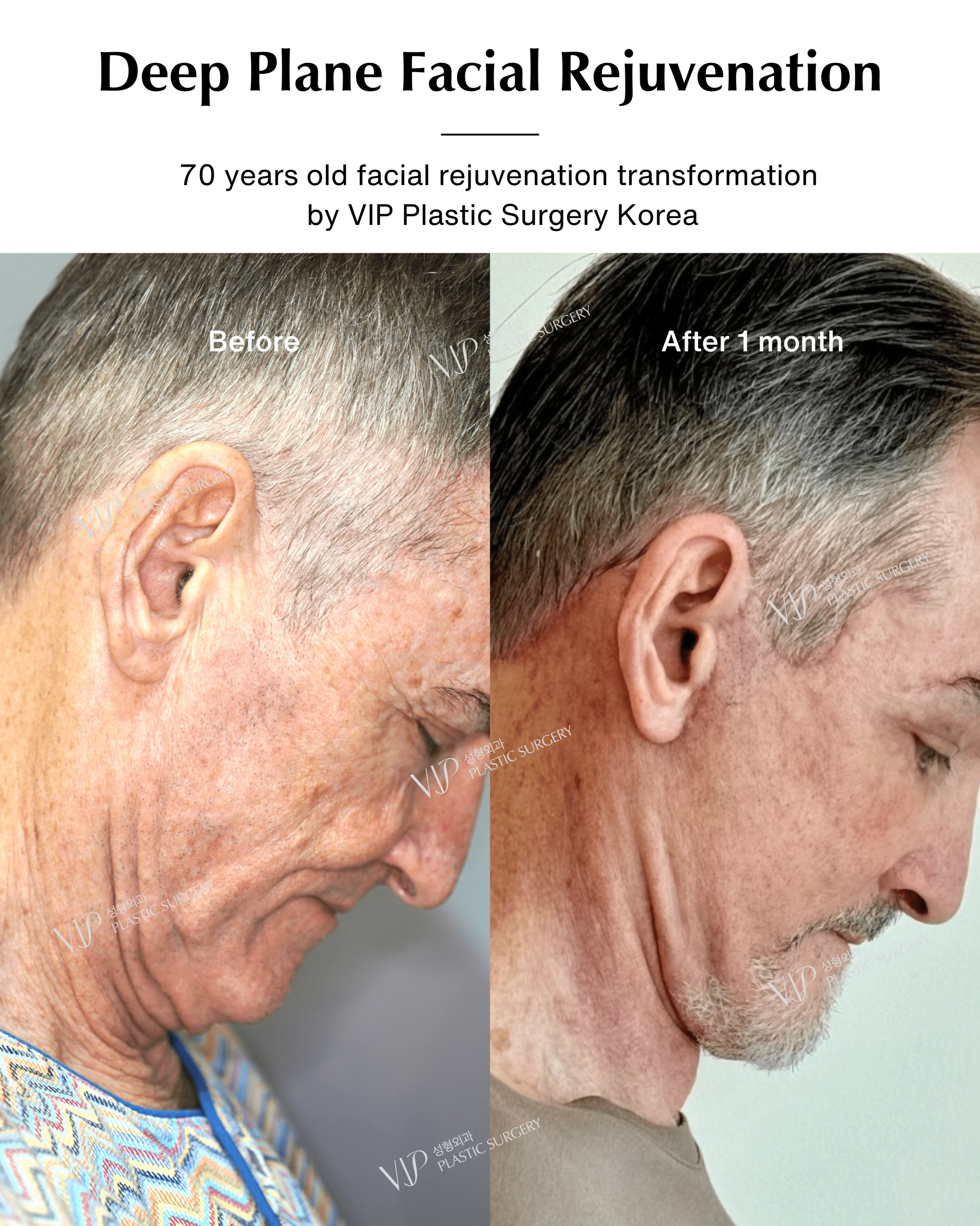 male deep plane facelift before after chin down2