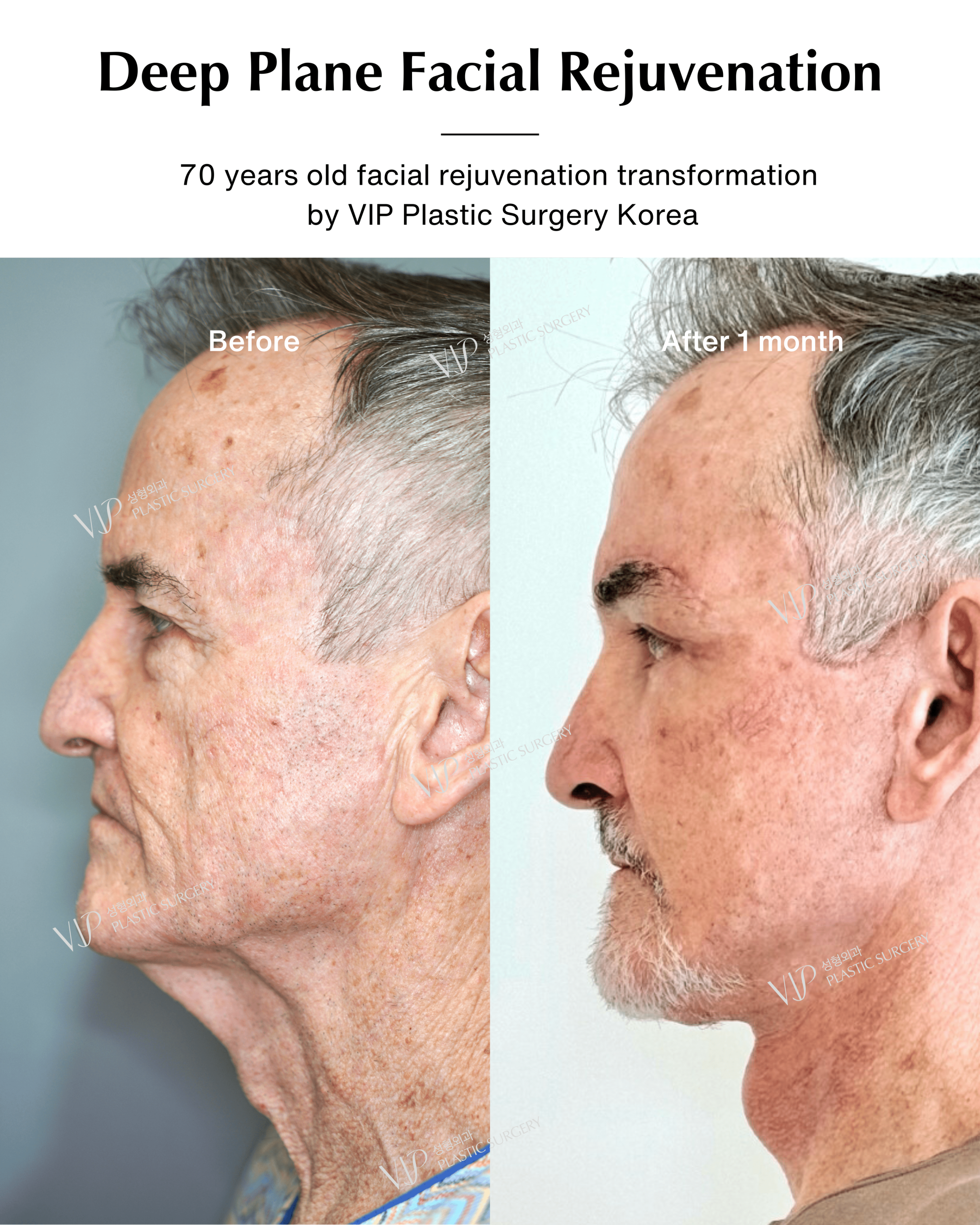 male deep plane facelift before after side