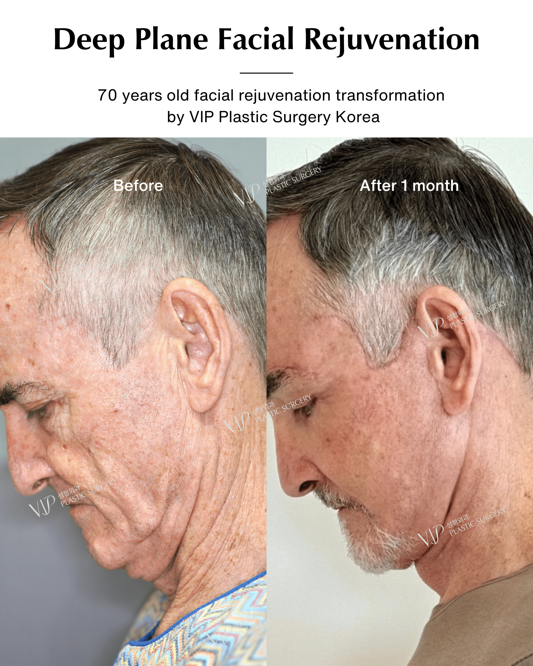 male deep plane facelift before after chin down