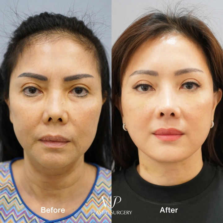 Deep Plane Facelift and Neck lift 10- months transformation 3