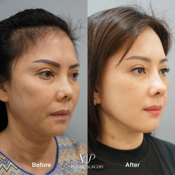 Deep Plane Facelift and Neck lift 10- months transformation 4