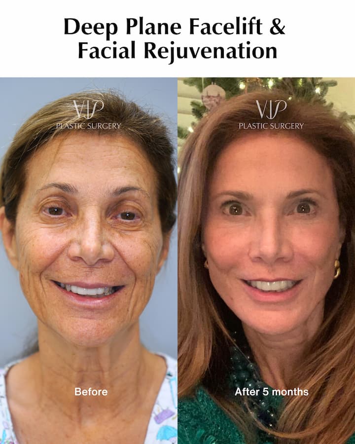 At VIP Plastic Surgery, when patients share their experiences after facial rejuvenation, they don't just talk about looking younger. Deep Plane Facelift & Facial Rejuvenation