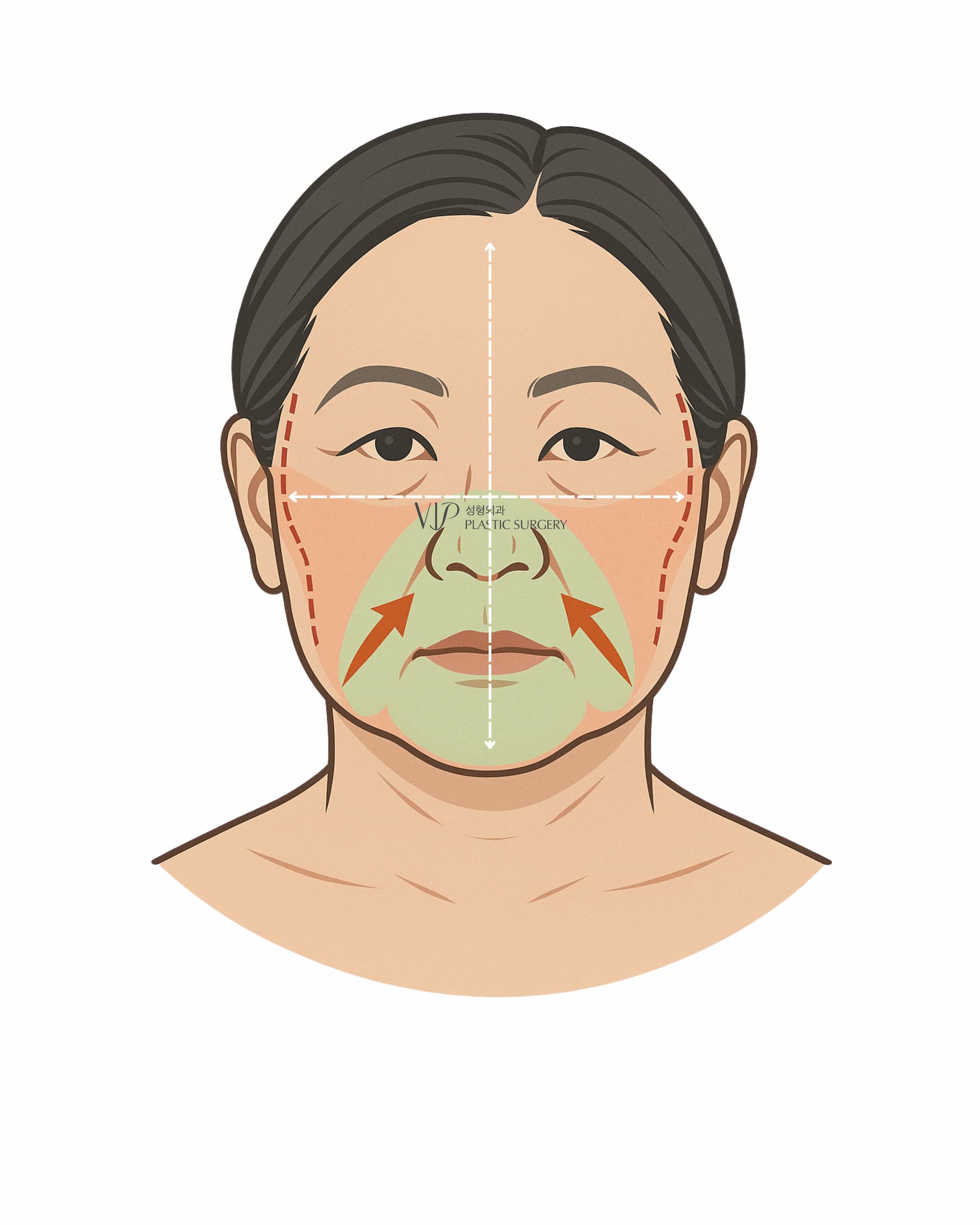 Distinctive Asian Facial Characteristics That Facelift Results