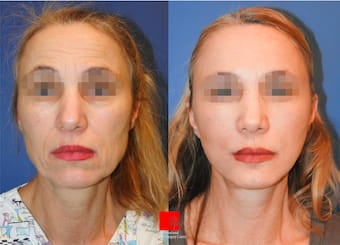Plastic surgeons highly focus on below criteria for successful facial rejuvenation.