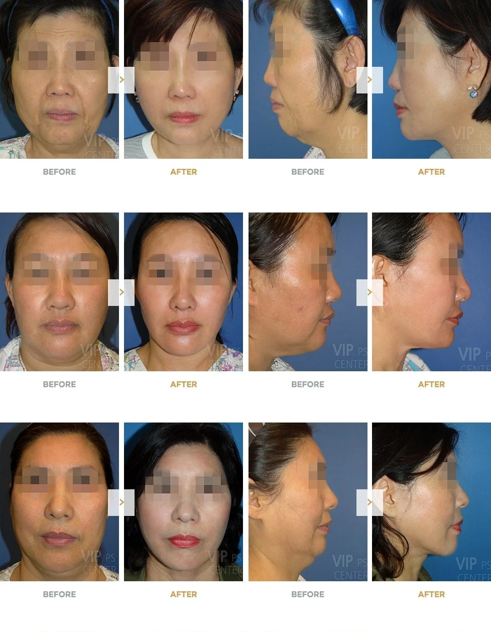 Deep Plane Facelift Before and After Gallery
