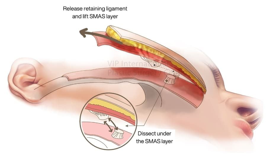 SMAS Layer