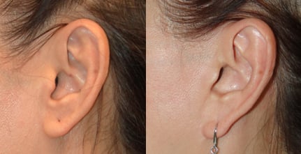 Dr. Lee's Invisible Ear Incision Line