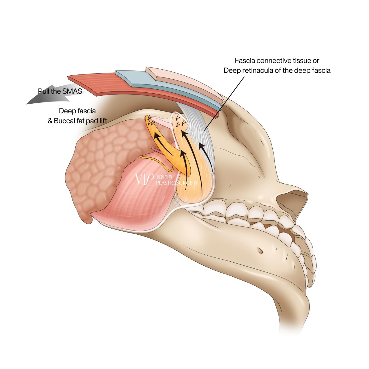 Dr. Lee may incorporate specialized procedures during the extended deep plane facelift to achieve optimal results.