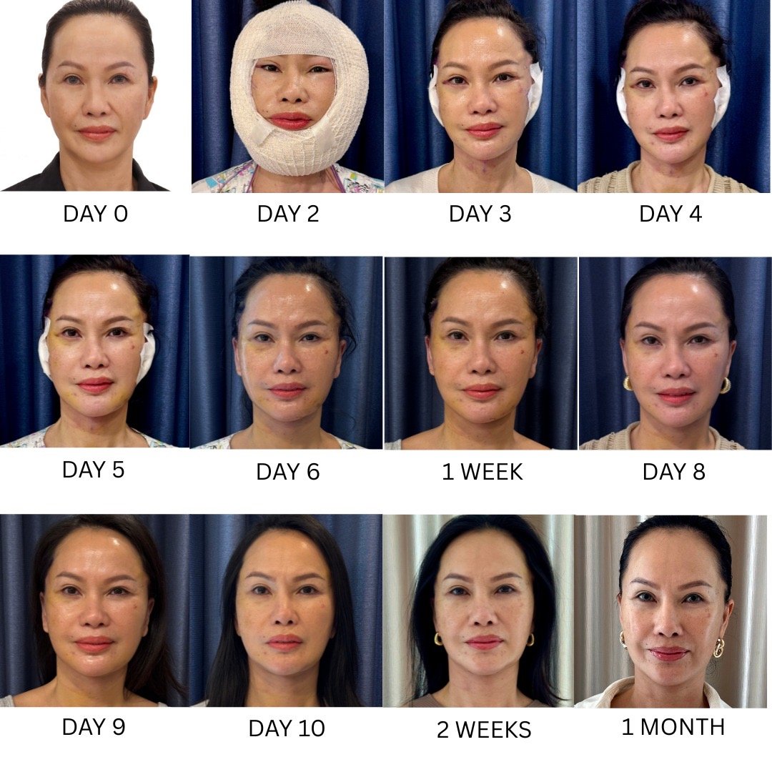 Recovery Timeline of an Extended Deep Plane Facelift