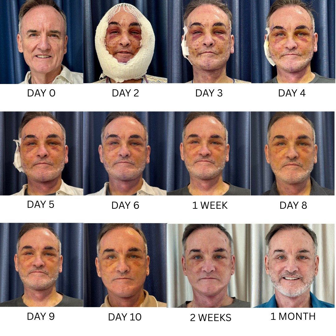 Recovery of an Extended Deep Plane Facelift