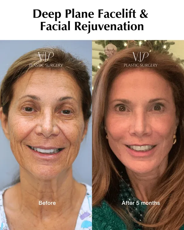 Deep Plane Facelift before after gallery 5 months