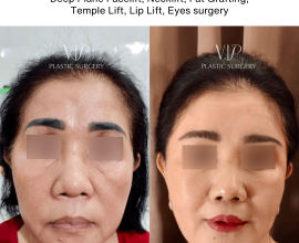 Facial Rejuvenation – 2 Years Post Operation