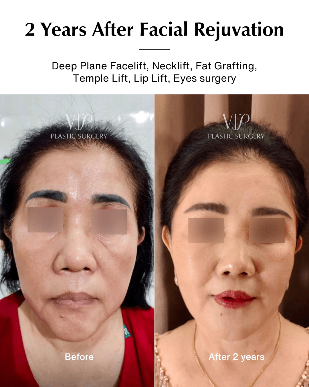 facial rejuvenation