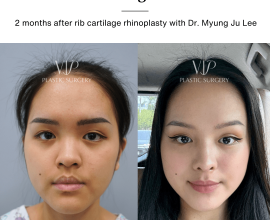 Asian Rib Cartilage Rhinoplasty