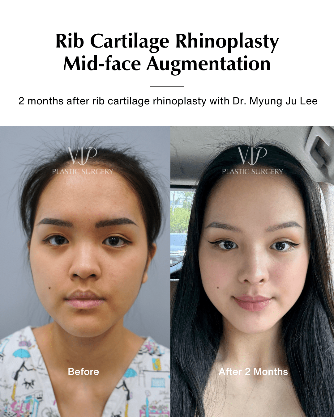 asian rhinoplasty