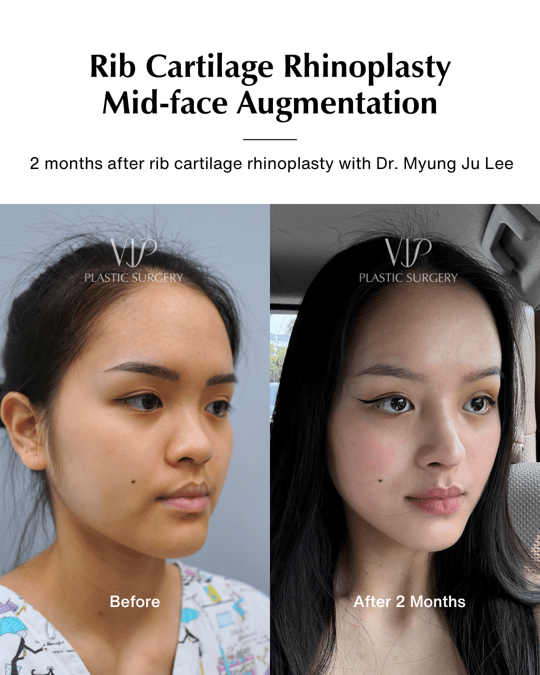 asian rhinoplasty before after