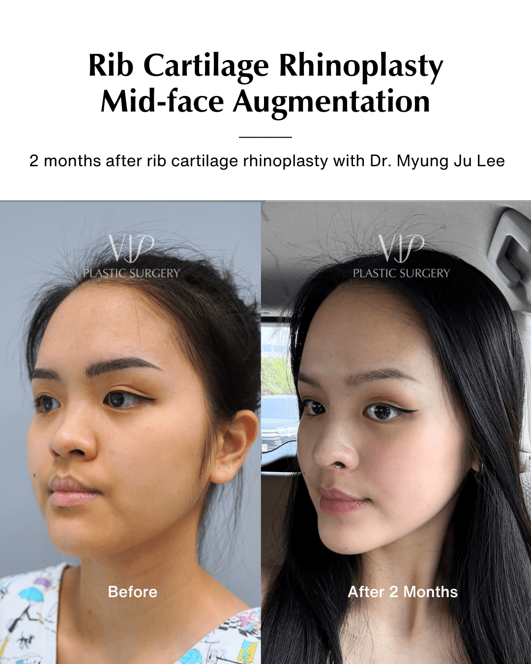 asian rhinoplasty before after