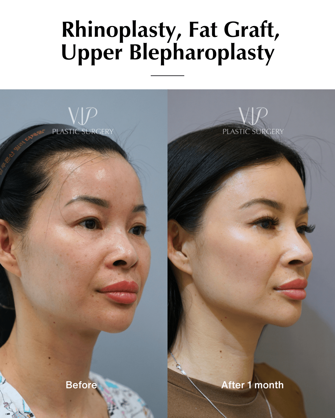 asian rhinoplasty 45 2