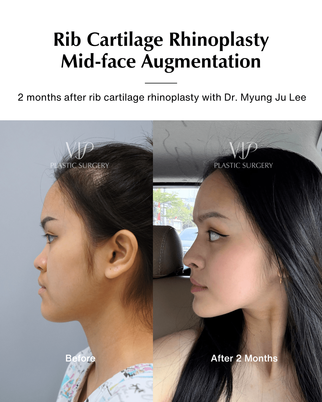 asian rhinoplasty before after
