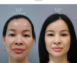 Asian Rhinoplasty & Fat Grafting