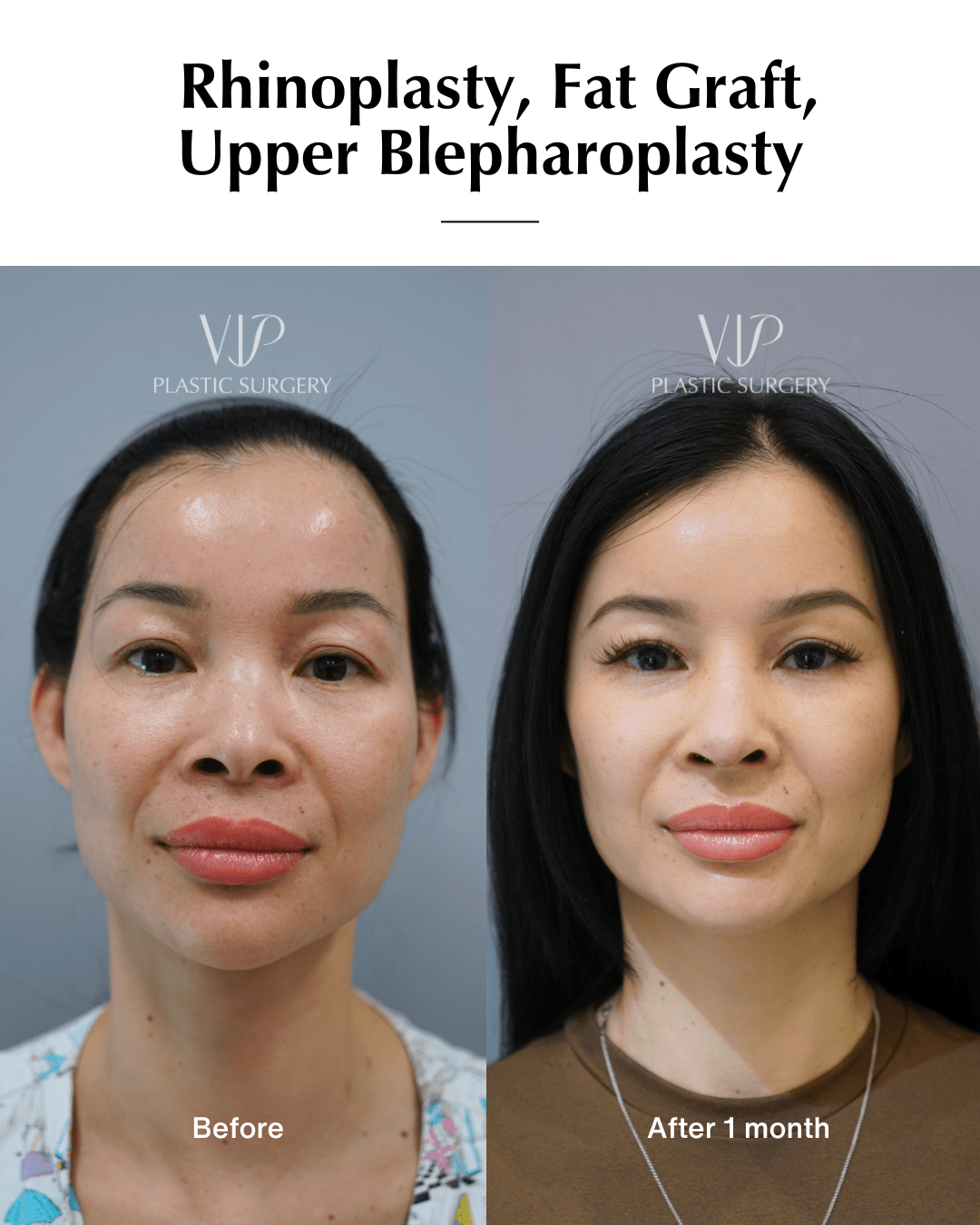 asian rhinoplasty front