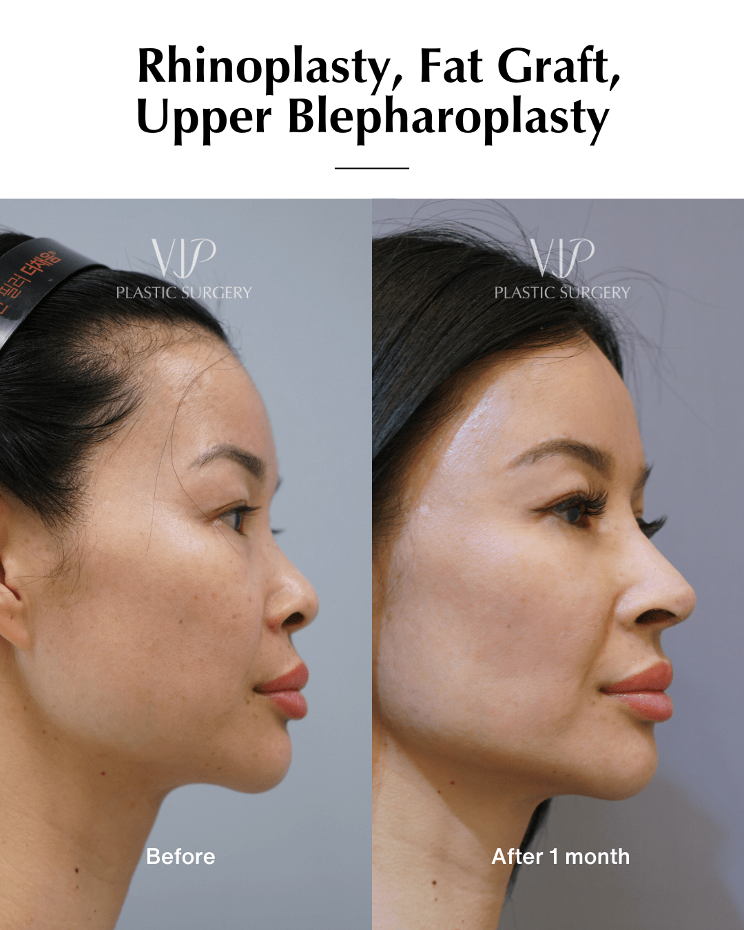 asian rhinoplasty side 2