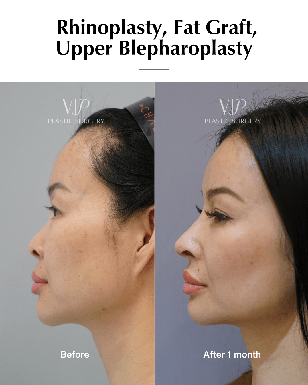 asian rhinoplasty side