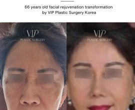 Facial Rejuvenation and Rhinoplasty