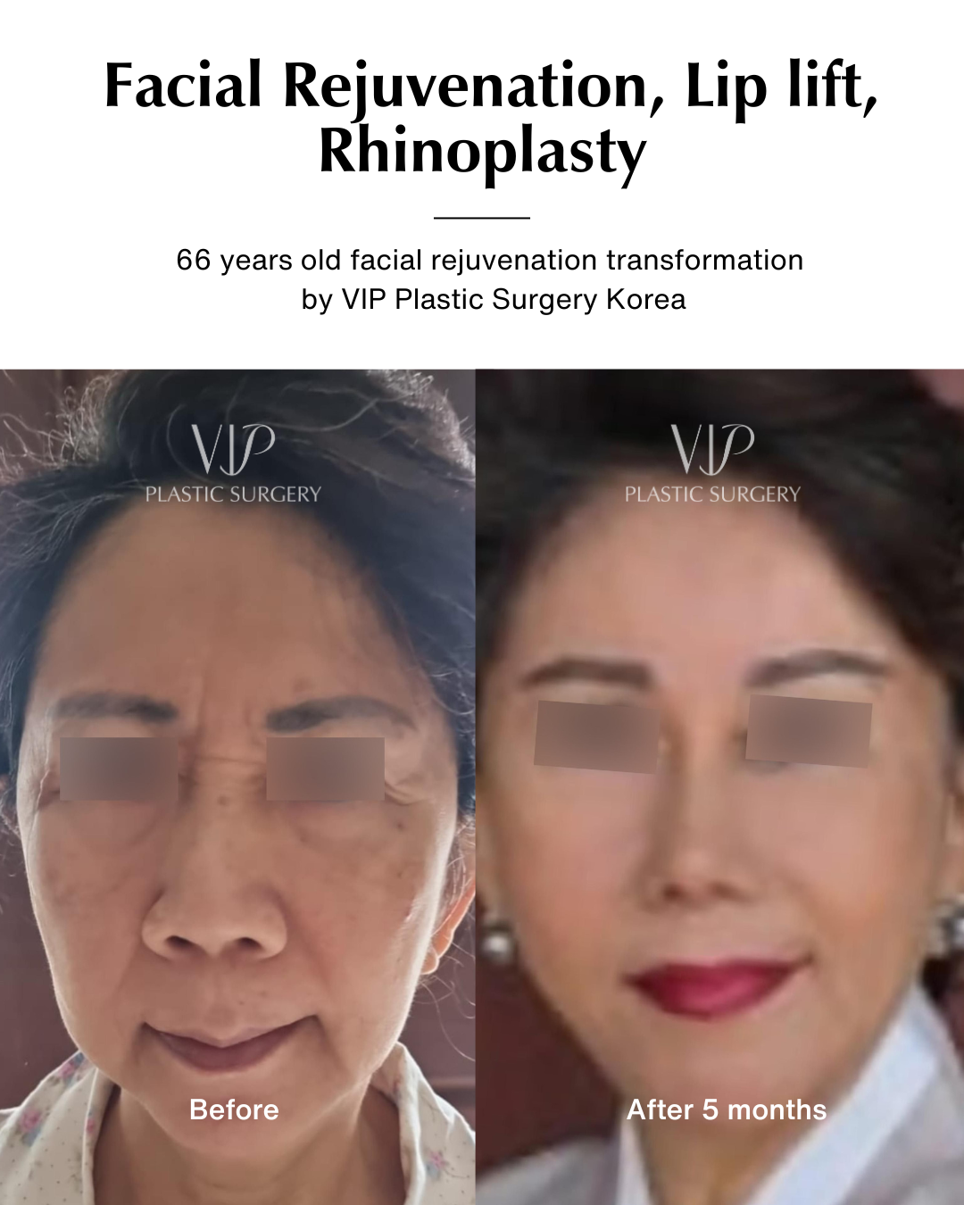 facelift and rhino